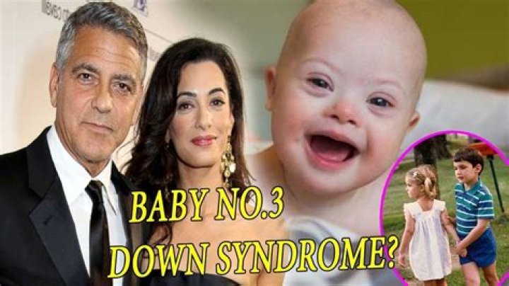 Understanding The Clooney Twins And Down Syndrome: A Comprehensive Insight